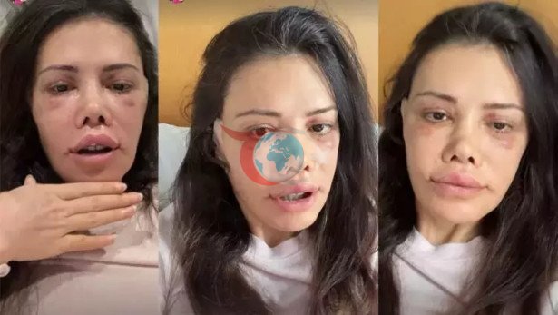 Yüz nakli yaptıran Didem Ceran'dan kötü haber
