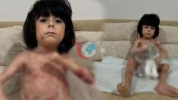 Yaraları tüm vücudunu sardı! 4 yıldır mücadele ediyor: Çaresiz durumda