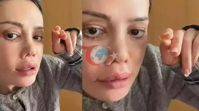 Yüz nakli yaptıran Didem Ceran: "Yüzü nakledilen kişinin alnı kaşıma denk geldi" - Resim : 2