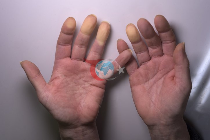 Soğuk Havalarda Parmak Morarmasına Dikkat! Raynaud Fenomeni Belirtisi Olabilir