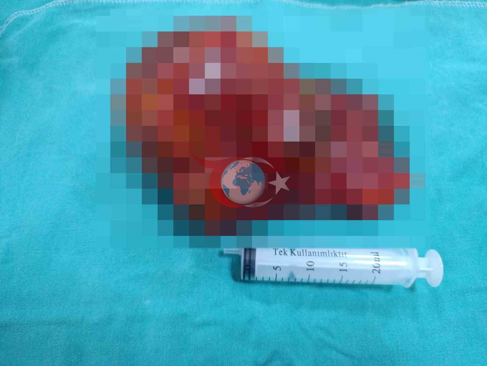 Malatya’da 20 santimetrelik kitle kapalı yöntemle çıkarıldı