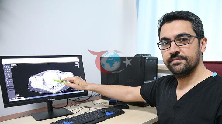 Doktorları Bile Şaşırtan Ameliyat: Beklenmedik Taşlar Çıktı