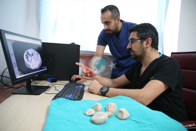 Doktorları bile şaşırttı! 43 yaşındaki kadının idrar kanalı ve mesanesinden 6 taş çıktı - Resim: 1