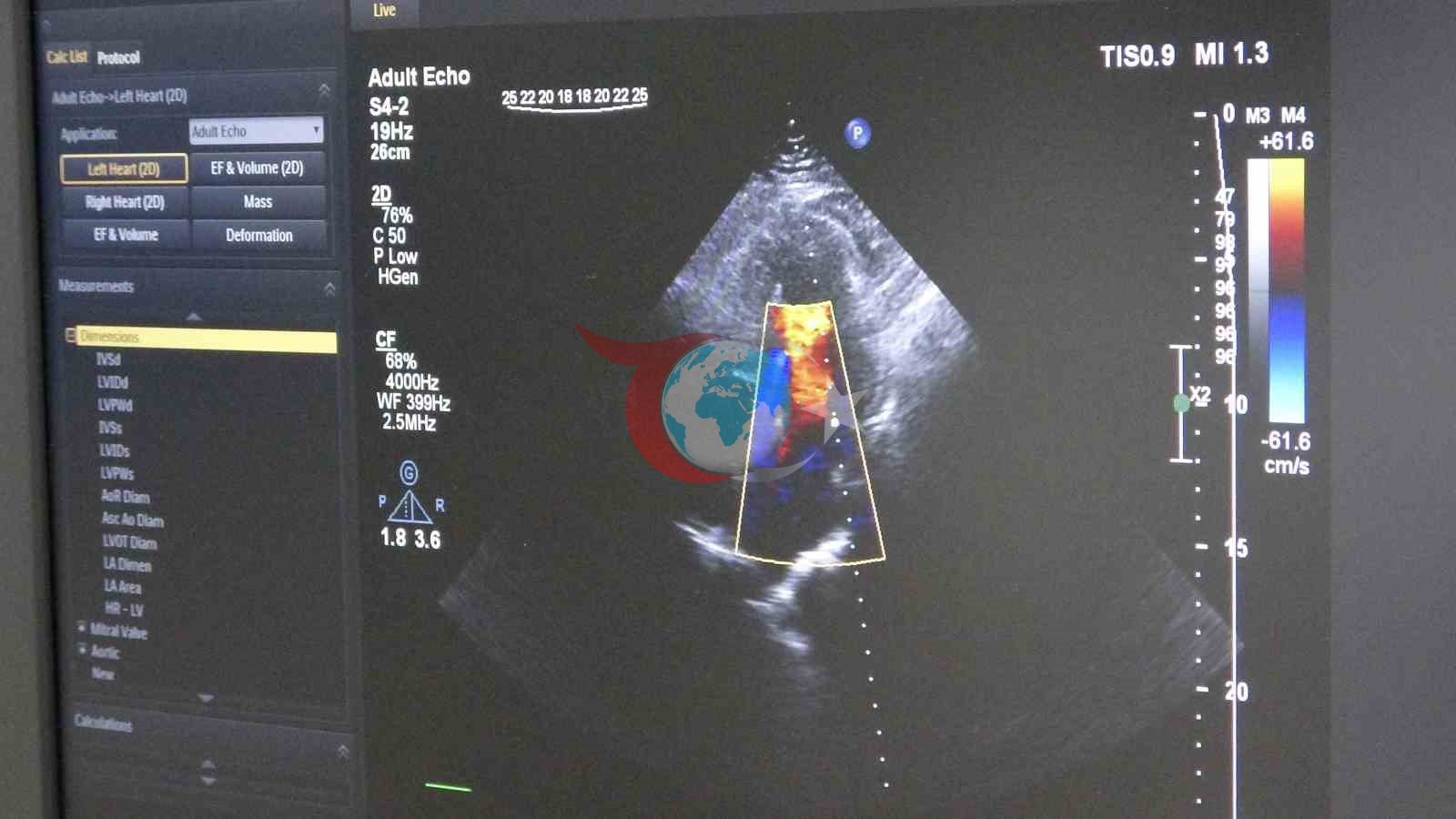 Ameliyatsız, stentsiz tedavi: Kalp damarları ilaç kaplı balonla açıldı