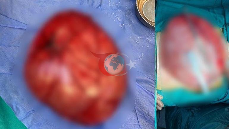 Kilo vermek için hastaneye gitti 14 yaşındaki çocuğun karnından çıkan şaşkına çevirdi