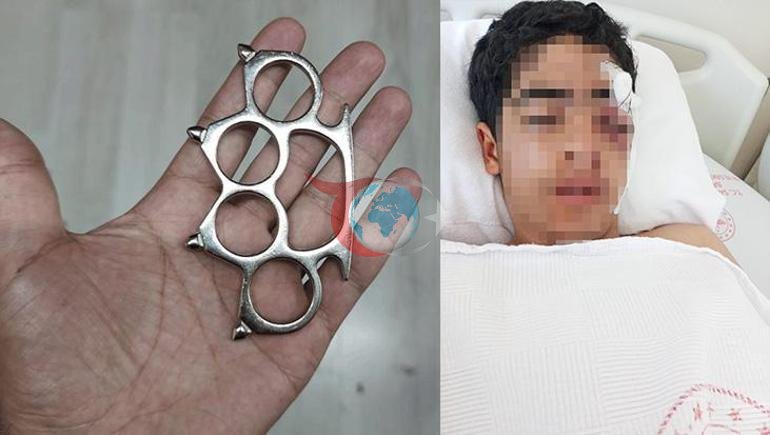 Esenyurt’ta akran dehşeti Gözünü kaybetme riskiyle ameliyata alınan çocuğun yüz kemikleri kırıldı