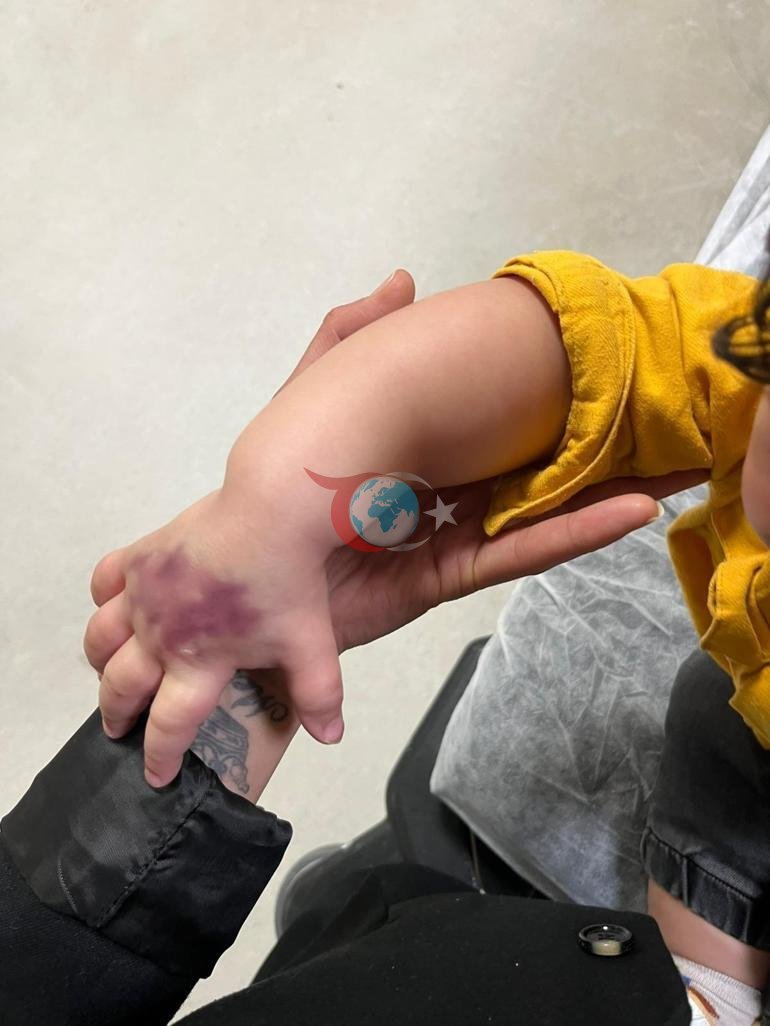 1,5 yaşındaki bebek tomografiyi alındı, kabus başladı: Çocuğumun kolu dirseğe kadar açıldı