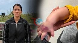 Doktor ‘bir şeyi yok’ dedi! Her şey morarmayla başladı: Çocuğumun kolu dirseğe kadar açıldı