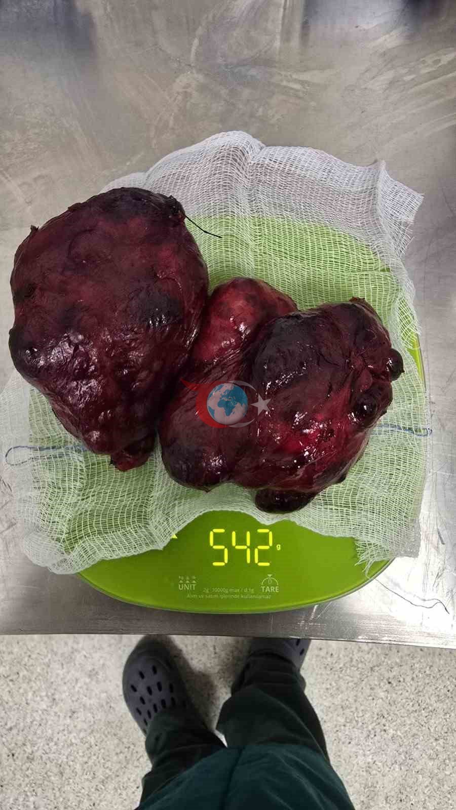 Boynundaki 542 gramlık kitle başarıyla çıkarıldı