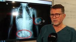 Parkta buldu, şeker diye yuttu! 4 yaşında çocuğu ölümden döndüren süreç röntgen filminde: Hareket halinde