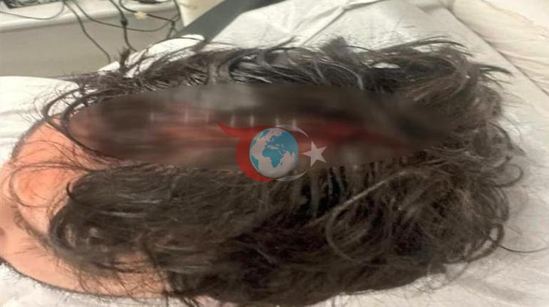 Beyoğlunda gedərkən böyük ağrıdan ürkdü. Başında 7 tikiş var idi