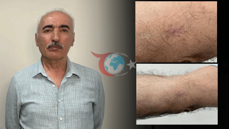 75 Yaşındaki Adamın Kolundaki Yara Kanser Çıktı: Erken Tanı Hayat Kurtardı