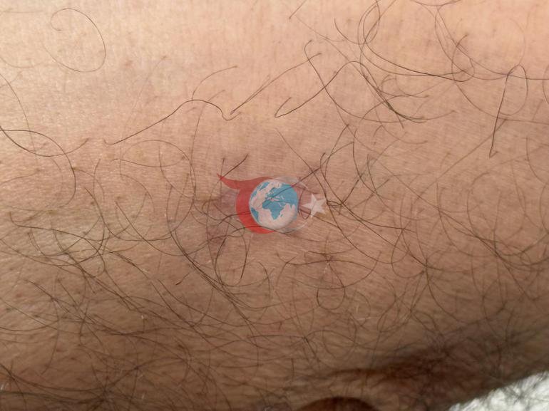 Kolundaki 1 santimetrelik yara aylarca geçmedi Hastanede gerçeği öğrenince şoke oldu