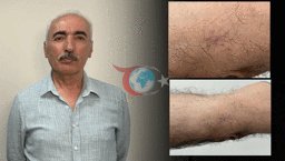 Kolundaki 1 santimetrelik yara aylarca geçmedi! Hastanede gerçeği öğrenince şoke oldu