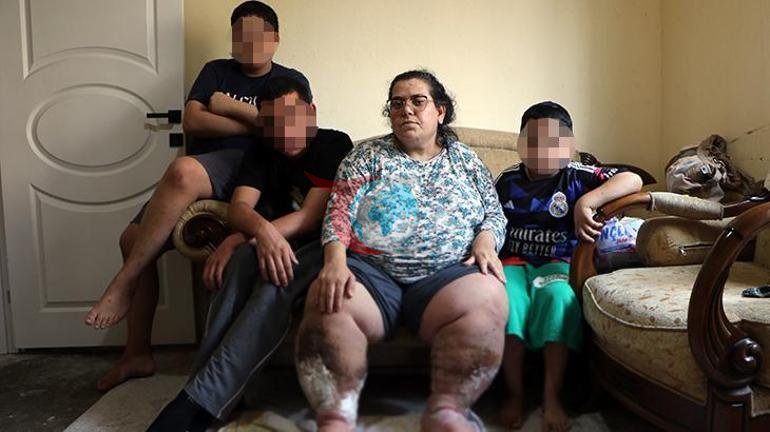 Пил оорусу менен ооруган 3 баланын энеси дарылануу үчүн жардам күтүүдө: Жарааттарда курттар пайда болууда 