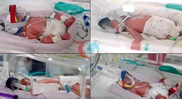 15 milyonda bir dəfə baş verən möcüzəli doğuş Eyni dördəmlər doğuldu