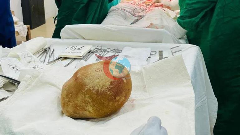 Sri Lankada akılalmaz ameliyat: Hastadan 3.1 kiloluk mesane taşı çıkarıldı