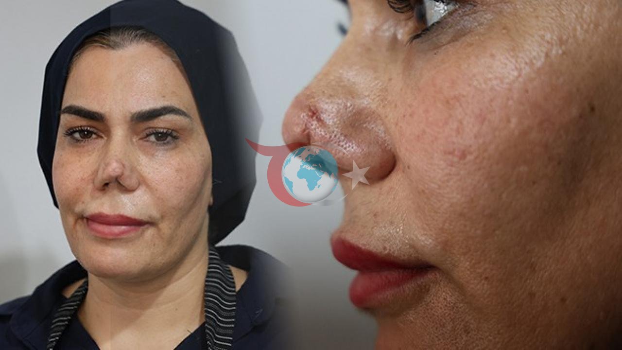 Elazığda tibbi səhv iddiası: 4 əməliyyatdan sonra qırılan burnu tanınmaz hala gəldi
