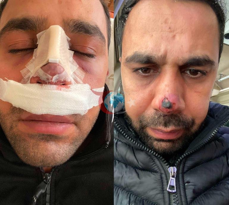 Burun ameliyatı sonrası hayatı kabusa döndü 40 bin avroluk tedavi çıktı