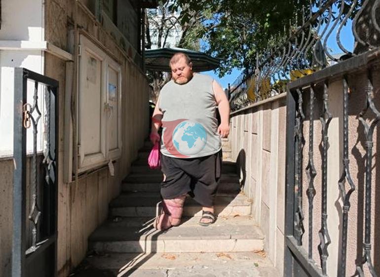 4 yıldır fil hastalığıyla mücadele ediyor Yürümek için 82 kilo vermesi gerekiyor