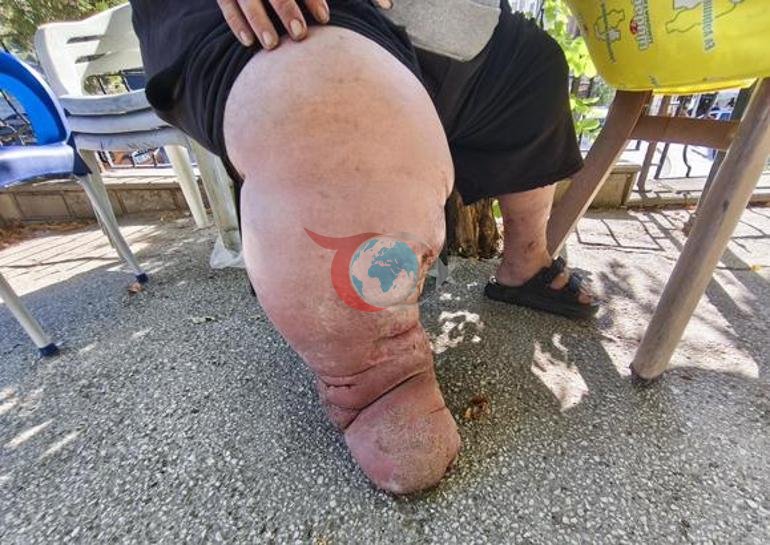 4 yıldır fil hastalığıyla mücadele ediyor Yürümek için 82 kilo vermesi gerekiyor