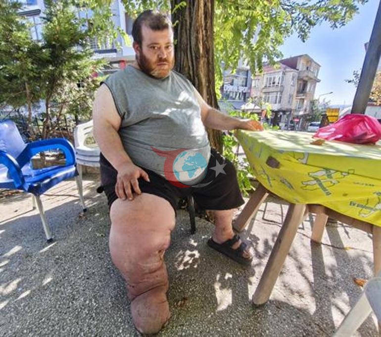 4 yıldır fil hastalığıyla mücadele ediyor Yürümek için 82 kilo vermesi gerekiyor