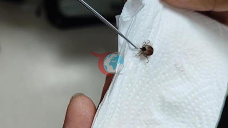 Bir aydır kulak ağrısı çekiyordu Kulağında canlı kene bulundu