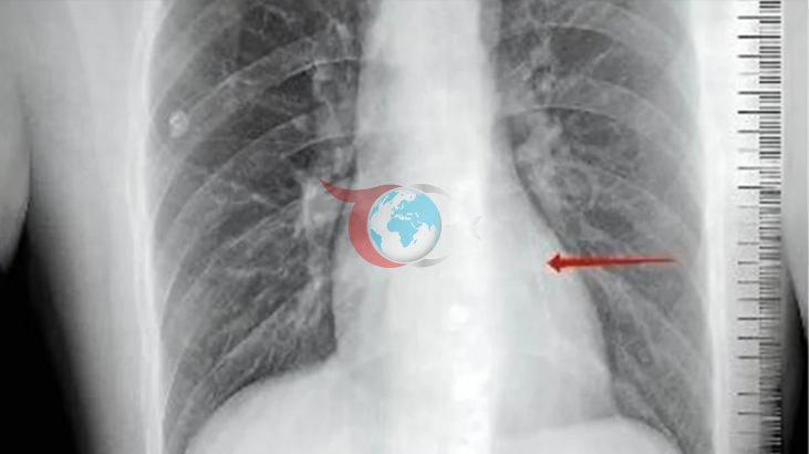 Tıp Dünyasını Sarsan Röntgen Görüntüsü: Kalbinden ve Organlarından Onlarca İğne Çıktı!
