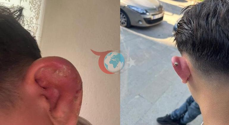 Piercing sonrası hastanelik olmuştu Korkunç olay sonrası yeni gelişme